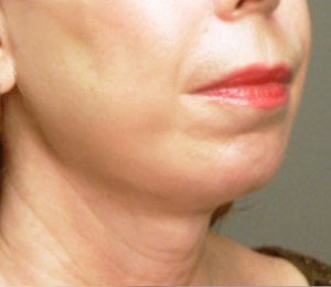 Injectables and Fillers