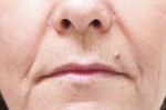 Laser Resurfacing