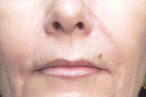 Laser Resurfacing