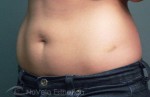 Body Fat Pockets