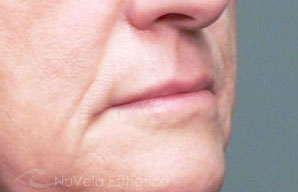 Lip Enhancement