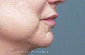 Lip Enhancement