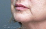 Lip Enhancement