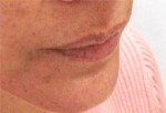 Lip Enhancement