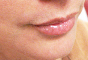 Lip Enhancement