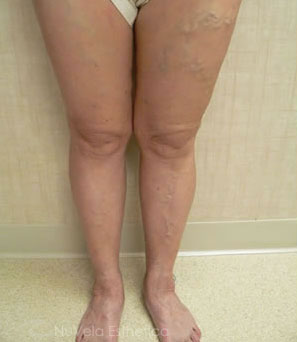 Foam Sclerotherapy