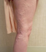 Foam Sclerotherapy