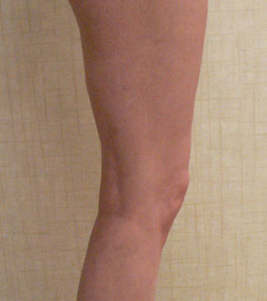 Foam Sclerotherapy