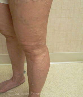 Foam Sclerotherapy