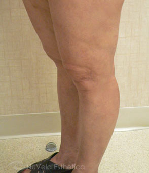 Foam Sclerotherapy