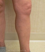 Foam Sclerotherapy