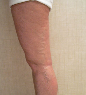 Foam Sclerotherapy