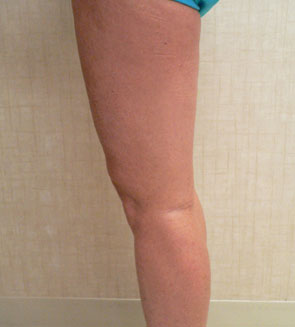 Foam Sclerotherapy