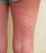 Foam Sclerotherapy