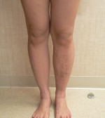 Foam Sclerotherapy