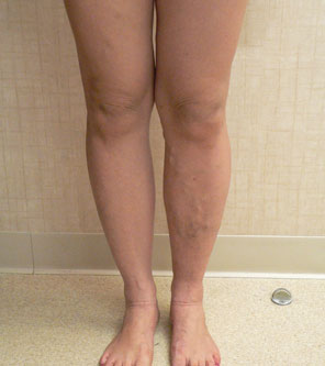 Foam Sclerotherapy