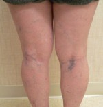 Sclerotherapy and Laser Vein Treatment