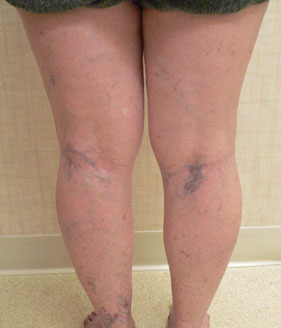 Sclerotherapy and Laser Vein Treatment