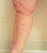 Sclerotherapy and Laser Vein Treatment