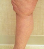 Sclerotherapy and Laser Vein Treatment