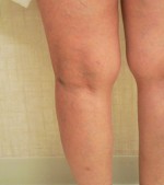 Sclerotherapy and Laser Vein Treatment