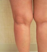 Sclerotherapy and Laser Vein Treatment