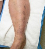 Sclerotherapy and Laser Vein Treatment