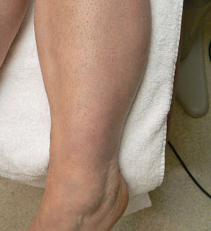 Sclerotherapy and Laser Vein Treatment
