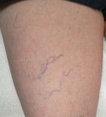 Sclerotherapy and Laser Vein Treatment