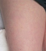 Sclerotherapy and Laser Vein Treatment