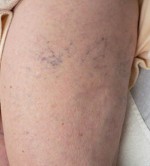 Sclerotherapy and Laser Vein Treatment