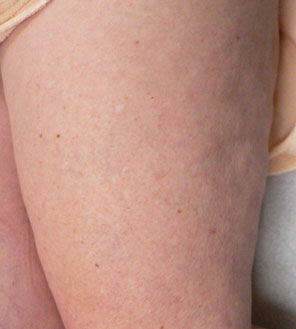 Sclerotherapy and Laser Vein Treatment