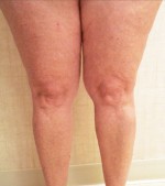 Sclerotherapy and Laser Vein Treatment