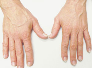 Hand Rejuvenation