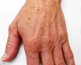 Hand Rejuvenation