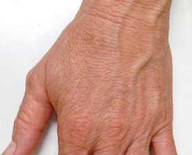 Hand Rejuvenation