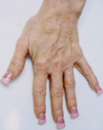 Hand Rejuvenation