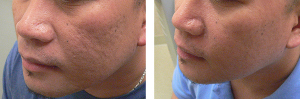acne scarring before and after fractional laser surgery
