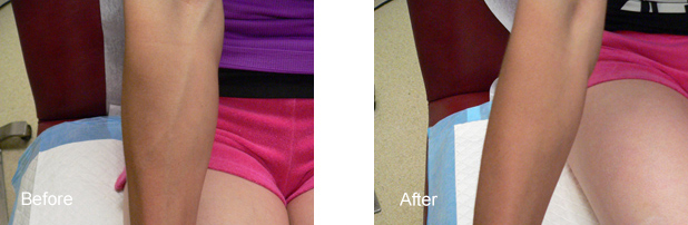 ARMS BEFORE AND AFTER SCLEROTHERPY1