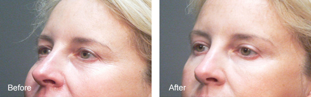 Botox Dysport Before & After Los Angeles