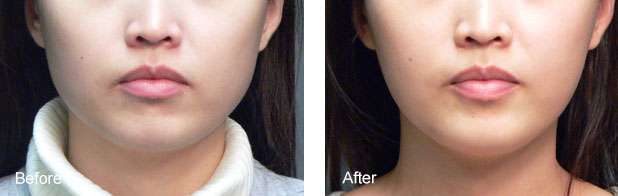 Botox Dysport Before & After Los Angeles