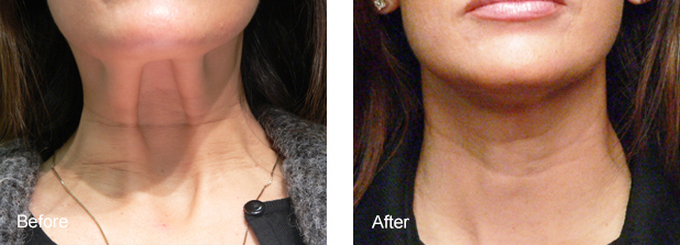 BOTOX FOR NECK BANDS1