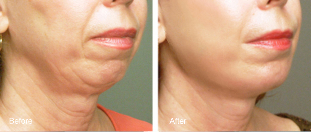 Fat Grafting to Chin and Jawline Results Los Angeles