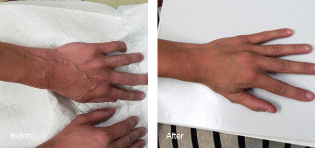 HAND AND ARM VEINS TREATED WITH SCLEROTHERAPY1