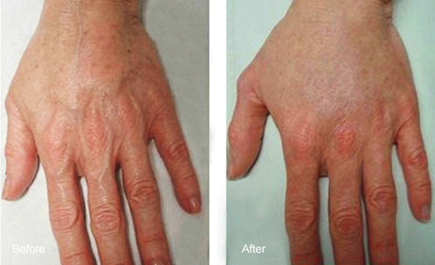 HAND REJUVENATION RADIESSE FILLER ONLY1