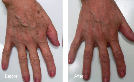 HANDS BEFORE AND AFTER IPL1