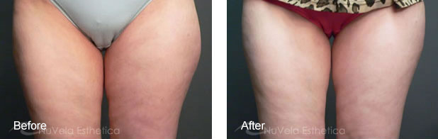 LIPOTHERAPY WITH LIPODISSOLVE INJECTIONS1