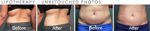 LIPOTHERAPY