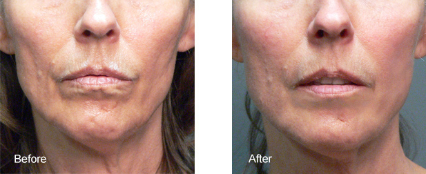 Sculptra Aesthetic Los Angeles Sculptra Face Volumizer San Fernando Valley 