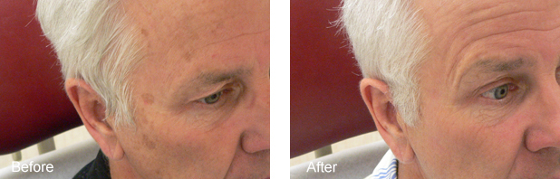 SUN AND AGE SPOTS TREATED USING IPL PHOTOREJUVENATION1